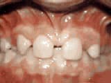missing-lateral-incisors-before