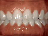 spacing-of-teeth-after spacing-of-teeth-after